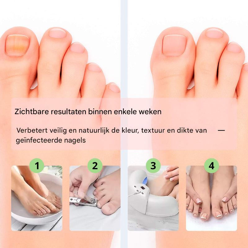 Laserapparaat voor het verwijderen van nagelschimmel